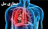 گسترش بیماری سل در سایه کرونا