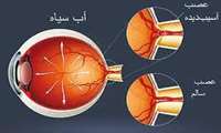 «آب سياه»، اختلال شايع بينايي در سنين بالا