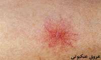 استفاده ازکرم ضد آفتاب، روش موثر پیشگیری از وریدهای عنکبوتی