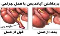 آپاندیست، شایع ترین اورژانس جراحی