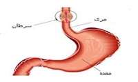 سرطان مری و معده؛ شایع ترین سرطان ها در خراسان شمالی