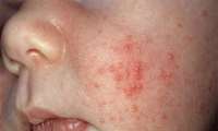 اجرای طرح پژوهشی مشترک دانشگاه با مؤسسه ملی توسعه تحقیقات علوم پزشکی