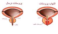 بزرگی خوش خیم پروستات، شایع ترین مشکل اورولوژی دوران سالمندی