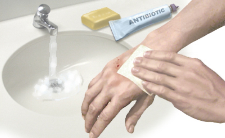 پیشگیری از ابتلا به هاری با شستشوی زخم پس از حیوان گزیدگی