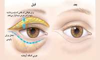 پاسخ یک‌چشم پزشک به سؤالاتی درباره بلفاروپلاستی 