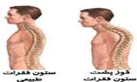 عوارض گرد پشتی یا کیفوز در کمین پشت میز نشینان