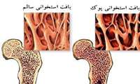 تحمل وزن و بالا بردن قدرت دو فاکتور مهم برای استحکام توده استخوانی