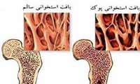 پوکی استخوان زودرس در کمین افراد مبتلا به بیماری های خونی