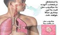 بهترین راه پیشگیری از بیماری سل درمان بیماران مبتلا است